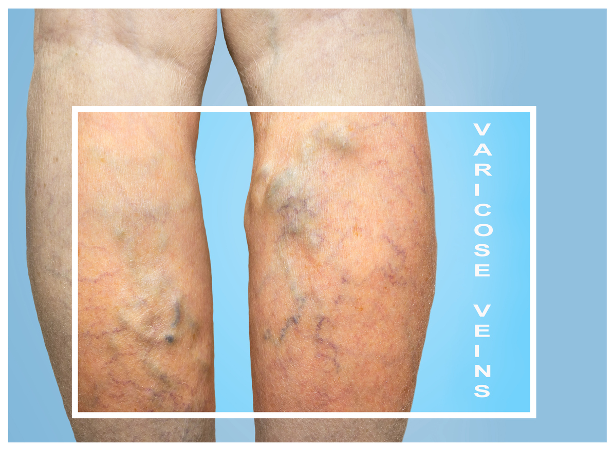 Are Varicose Veins Dangerous Is It Possible To Treat Varicose Veins